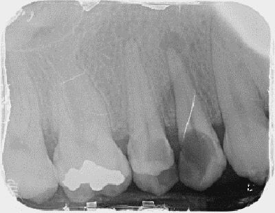 endodoncia premolares superiores