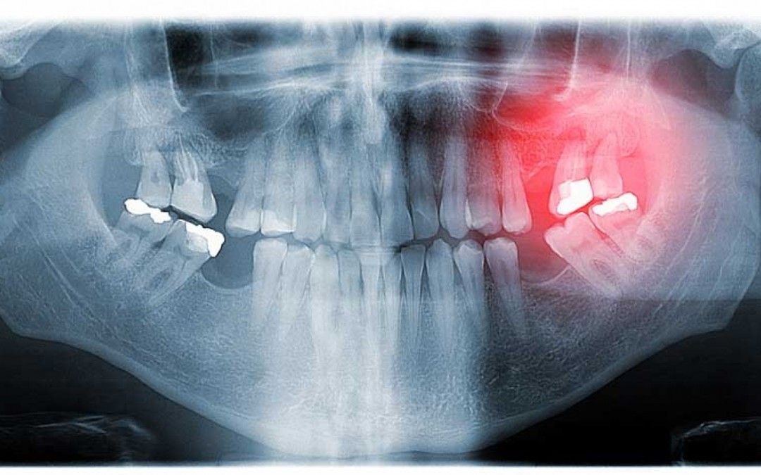 Consecuencias de la pérdida de un diente