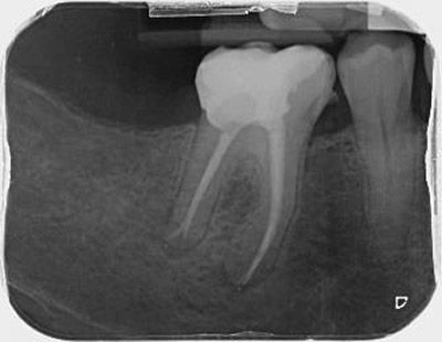 endodoncia premolar inferiror