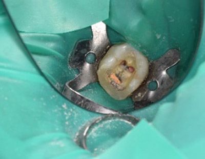 endodoncia premolar inferiror
