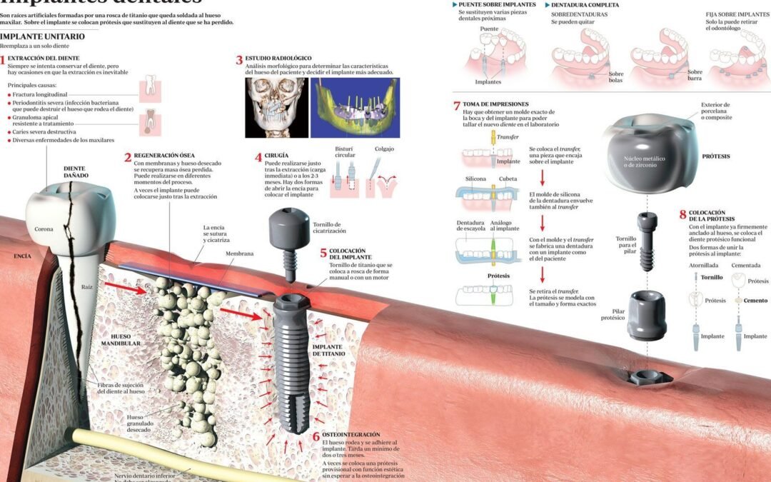 implante-dental